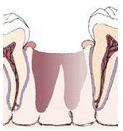 Фиброзная ткань в лунке формируется в костную ткань