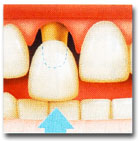 Коронка надевается на обточенный зуб